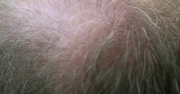 Haarwuchsmittel - Haarausfall stoppen und Haarwuchs beschleunigen