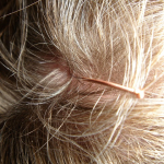 Kopfhautjucken und stressbedingter Haarausfall